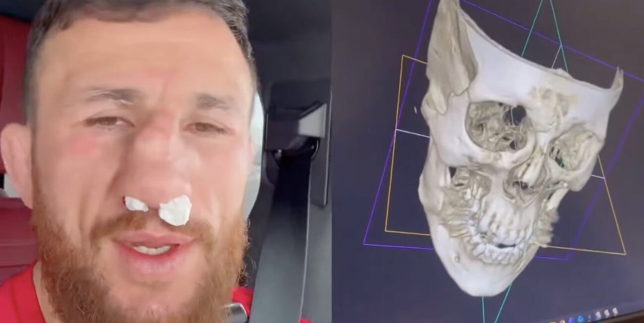 ძალიან მძიმე დაზიანებაა მიიღო მერაბ დვალიშვილმა